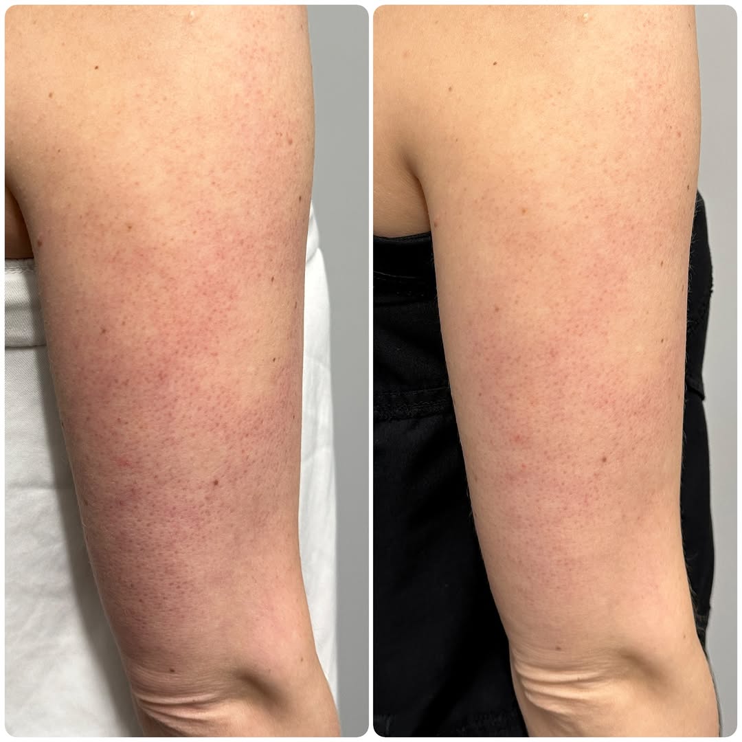 Lymfatisk Kropsbørste